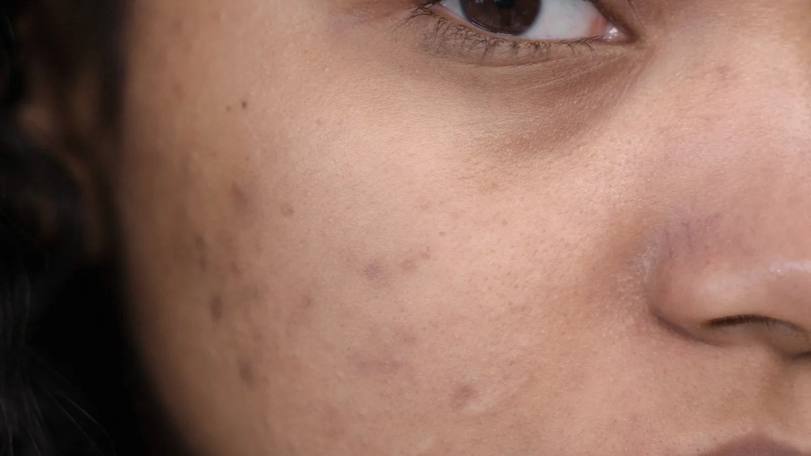 Acne and acne scar care, acne scar treatment, editorial journal image for Franciele Sofiati in Londrina on the journal article fractional co2 laser recovery and aftercare, image 5