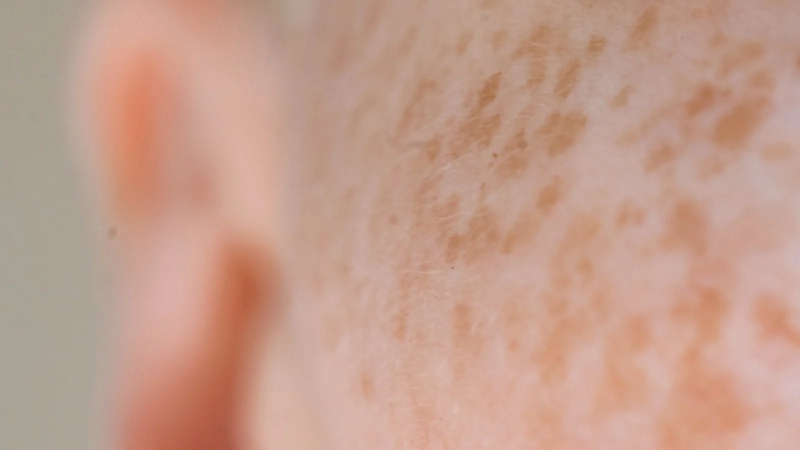 Close-up of natural facial pigmentation and freckles.